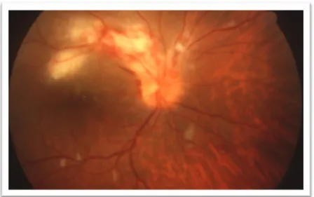 Figuur 10. Klassieke presentatie CMV retinitis (8) 