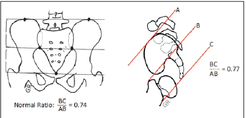 Figuur  2:  Sacrale  ratio:  hierbij  wordt  de  afstand  tussen  bepaalde  beenderige  structuren  gemeten  en  tegenover elkaar geplaatst