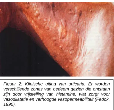 Figuur  2:  Klinische  uiting  van  urticaria.  Er  worden  verschillende  zones van oedeem gezien die  ontstaan  zijn  door  vrijstelling  van  histamine,  wat  zorgt  voor  vasodilatatie en verhoogde vasopermeabiliteit (Fadok,  1990)
