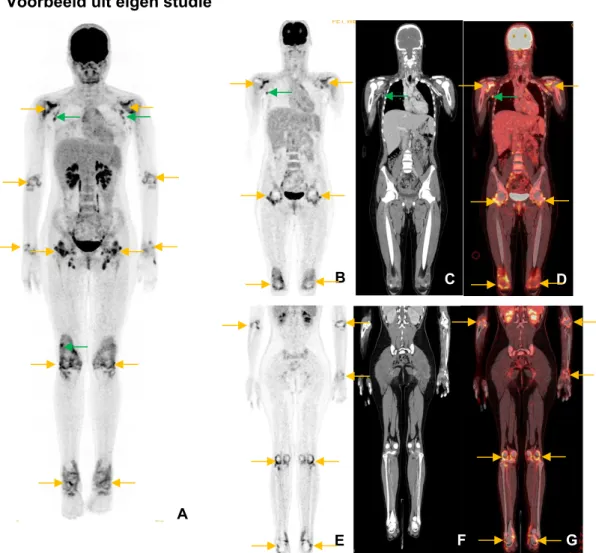 Figuur 10: (juveniele) reumatoïde artritis op  18 F-FDG PET/CT-beeldvorming. 