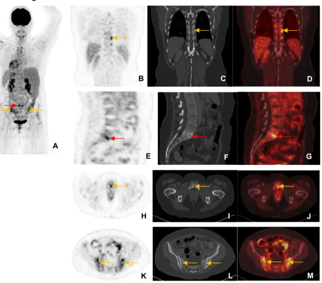 Figuur 13: axiale spondylartropathie op  18 F-FDG PET/CT-beeldvorming. 
