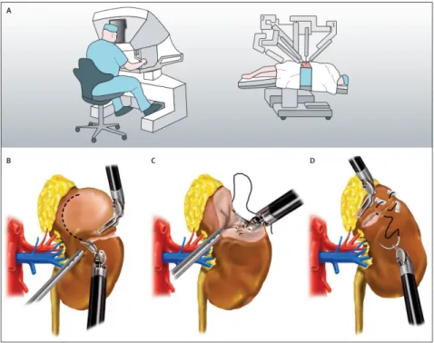 Figure 2.10: Overview of RAPN. (A) In robot-assisted surgery, instead of directly moving the instruments, the surgeon performs the normal movements associated with the surgery, and the robotic arms make those movements and use end-effectors and manipulator