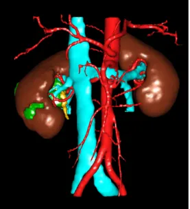 Figure 3.1: Example of a commercial virtual 3D model of a kidney with tumors provided by VisiblePatient ©