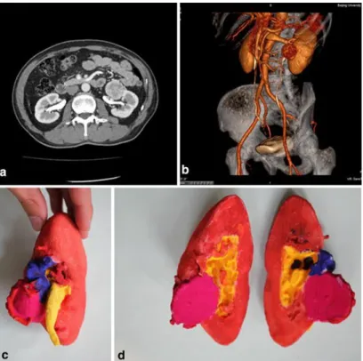 Figure 3.3: A hilar renal carcinoma of the left kidney. a) Standard contrast enhanced CT scan, b) CT reconstruction, c) 3D printed kidney model with the tumor, d) model sectioned with the maximal diameter of tumor