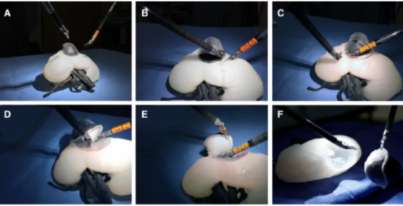 Figure 3.7: Pre-operative simulation of robotic partial nephrectomy using 3D model [8]