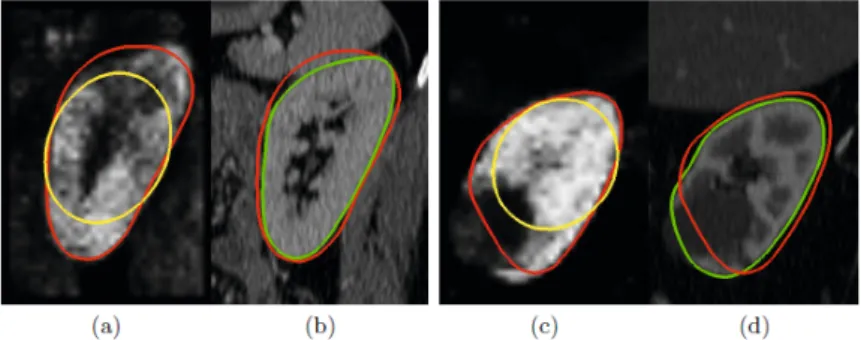Figure 4.4: Illustration of the two-step kidney segmentation on two cases: (a-b) non-contrasted volume of a healthy patient, (c-d) contrast-enhanced image of a kidney with a tumor.