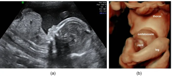 Figuur 5: a) Echografisch beeld van een foetus met een omphalocoele op 14 weken.  b) 3D reconstructie  van eenzelfde foetus met een omphalocoele op 18 weken