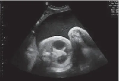 Figuur 6: Echografisch beeld van een ‘double bubble’-teken bij een foetus met duodenale atresie (55)