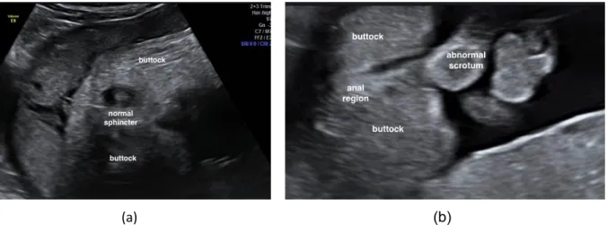 Figuur 7: a) Normaal echografisch beeld van de anale sfincter. b) Echografisch beeld van een foetus  met anale atresie