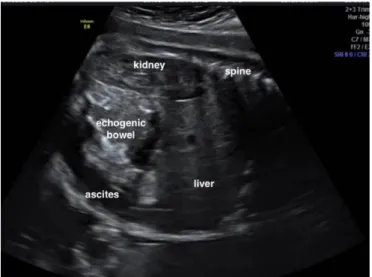 Figuur 8: Echografisch beeld van ascites bij een foetus met darmperforatie. 