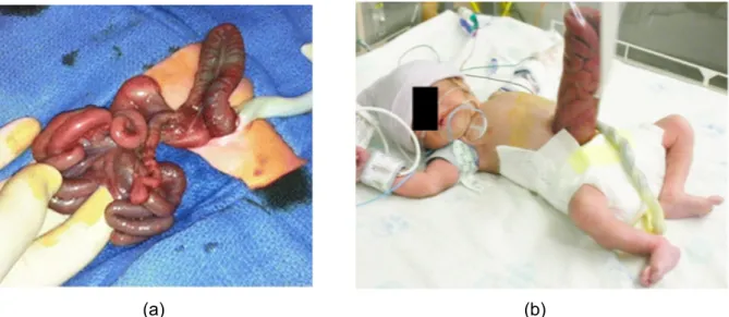 Figuur 1: a) Een neonatus met gastroschisis onmiddellijk na de geboorte. b) Een silo beschermt de  extra-abdominale organen van de neonatus indien het buikwanddefect secundair gesloten wordt (4)