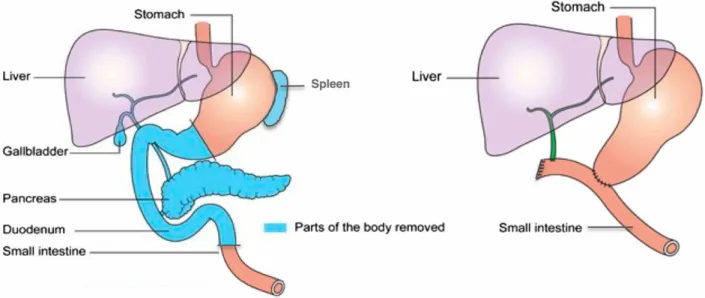 Figure 5: total pancreatectomy. Lund et al.