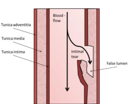 Figure 1. Mechanism of   an arterial dissection 