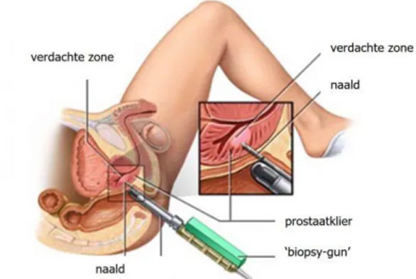 Figuur 1.4: Schematische voorstelling van de uitvoering van een transrectale ultrasound biopsie (25)