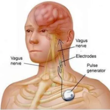 Figure 5. Implanted VNS electrode in a  patient. Figure from G. Bedi, 2014. 