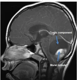 Figure 9. Cerebellar pilocytic astrocytoma  T2 weighted MRI. Image from Sievert and  Fischer, 2009