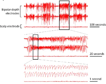 FIGURE  9.  Presentation  of  hippocampal  electrical  activity.  The first two signal lines  correspond  to  hippocampal  EEG  signals,  which  are  detected  with  implanted  bipolar  depth  electrodes