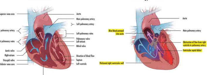 Figure 1.  Diagram of a healthy heart in contrast with a heart suffering from Tetralogy of Fallot