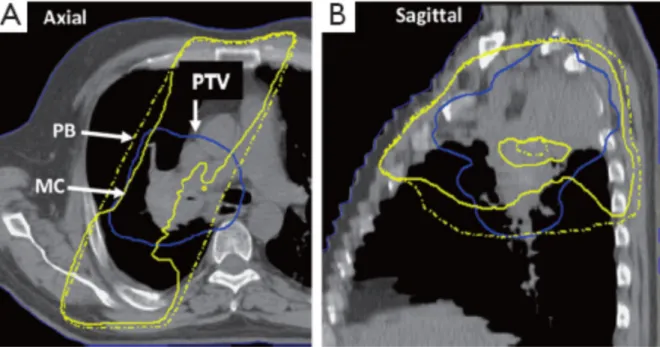 Figure 4. A treatment plan for a patient with locally advanced stage non-small cell lung cancer, shown  in  axial  (A)  and  sagittal  (B)  view
