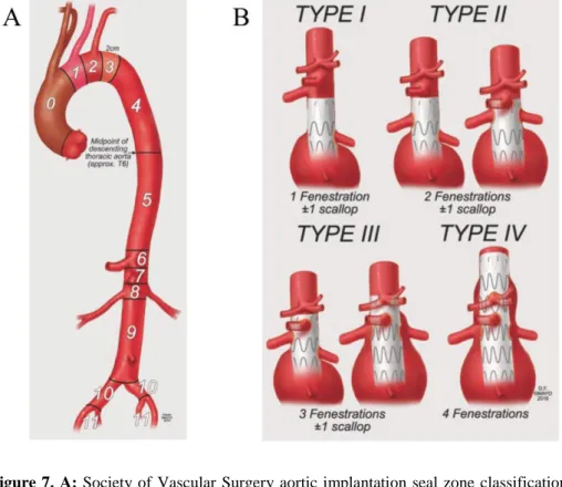 Figure 7. A: Society of  Vascular Surgery aortic implantation seal zone classification  system
