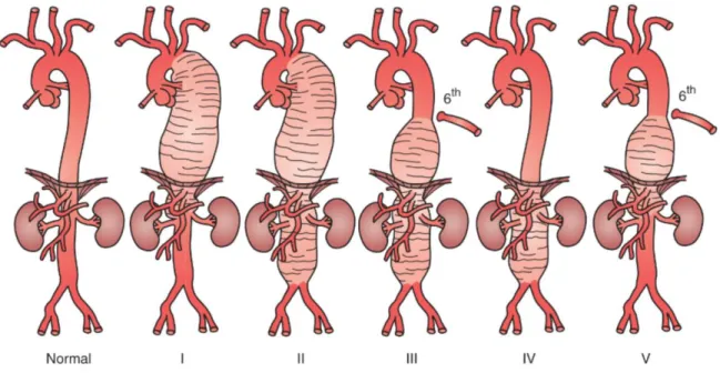 Figure 1. Crawford classification of thoracoabdominal aortic aneurysms. 1 