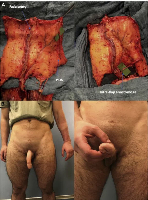 Figure 4. (Panel A) Intraoperative view of a FRFA, still attached to the forearm vessels, before (left) and after (right) intra-ﬂap anas- anas-tomosis