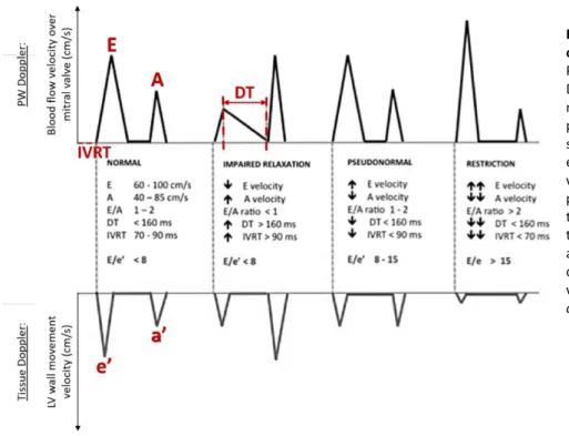 Figure 3. Theoretical filling patterns  of 4 stage of diastolic dysfunction. 