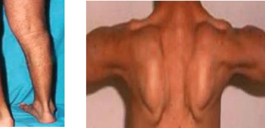 Figuur 3: Atrofie van musculus gastrocnemius  met bijhorend een contracuur van de  achillespees bij een patiënt met LGMD2A