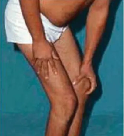 Figuur 5: Gower's sign bij een patiënt met LGDM2A: om vanuit  zit recht te komen duwt de patiënt zich af op de bovenbenen