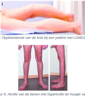 Figuur 9: Atrofie van de benen met hypertrofie ter hoogte van het   lateraal deel van de musculus gastrocnemius bij een patiënt met 