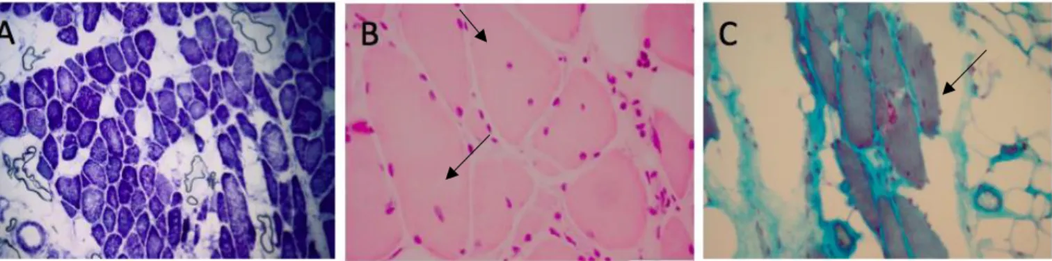 Figuur 13: Histochemische analyse van P1.  Foto A:  NADH-dehydrogenase kleuring: predominantie donkere type I vezels