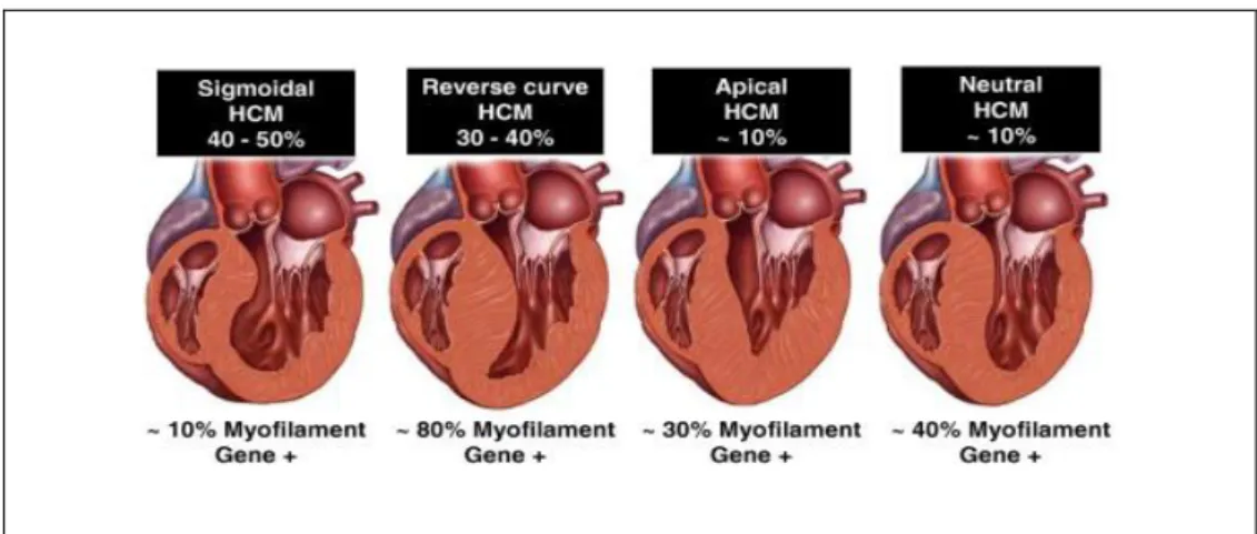 Figur 1. Septal morfologi vid HCM kan klassificeras som fyra subtyper; sigmoidal,  omvänd septumkurvatur, apikal och neutral