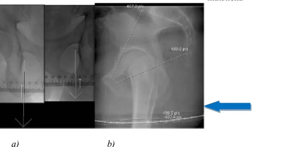 Figur 1 a) Mätpunkterna (markerat med pil) vid frontalprojektion- i ryggläge b) Mätpunkterna samt mätstickan vid  sidoprojektion i stående position