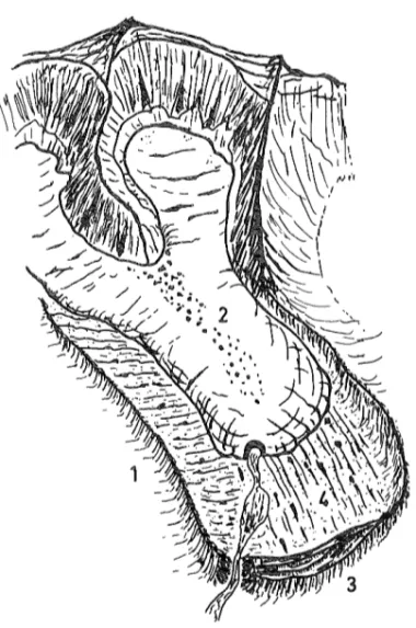 Fig  2  Ackumulationsformer  vid  nutida  glaciärer  Recent  moraine  features 