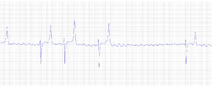 Figur  4.  EKG  från  häst  med  förmaksflimmer.  R-R  intervallen  är  oregelbundet  oregelbundna  och  P-