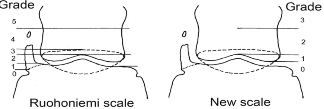 Figur 1. Graderingsskalor av hovbroskförbening enligt Ruohomiemi skalan och den nya skalan  (Hedenström et al