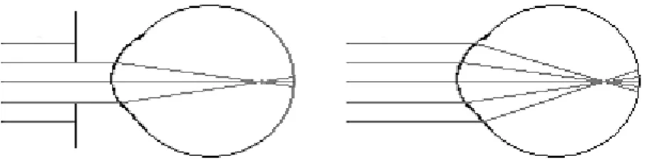 Figur 6. Bilden visar ljusstrålarnas träffyta på retina, med och utan avskärmning