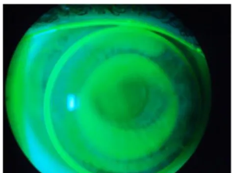 Fig. 8 Picture of an orthokeratology lens decentered inferiorly and laterally, with  fluorescein applied to the eye,  taken by Emelie Nilsson  