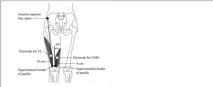 Figur 2. Elektrodplacering vid EMG-mätning av vastus medialis oblique (VMO) och vastus  lateralis (VL)