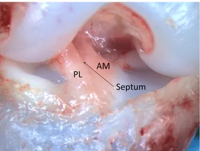 Fig. 1 “Dissection of a right knee. Showing that the ACL already has 2 bundles which are 
