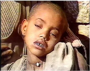 Fig. 1 Live aid Lead image of Ethiopian child ‘minutes away from dying’ in ‘The Famine video’, 1985