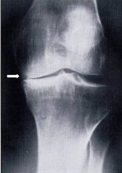 Fig 1. Røntgenbilde av kneartrose. Legg merke til den trange plassen (pil) mellom lårben og skinnben på medial  side på grunn av nedbrytning av leddbrusken