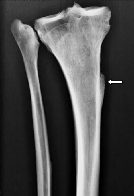 Fig 14. Røntgenbilde av høyre skinnben og leggben. Legg merke til bøyen proximalt på skinnbensdiafysen og  benpåveksten medialt på skinnbenet (pil)