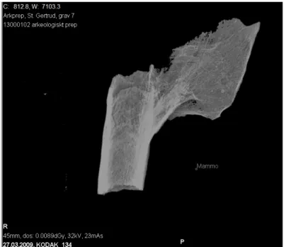 Fig 15. Mammografi-bilde av et benbrudd på lårbensdiafysen. Sett ventralt. Røntgenavdelingen på Visby  lasarett