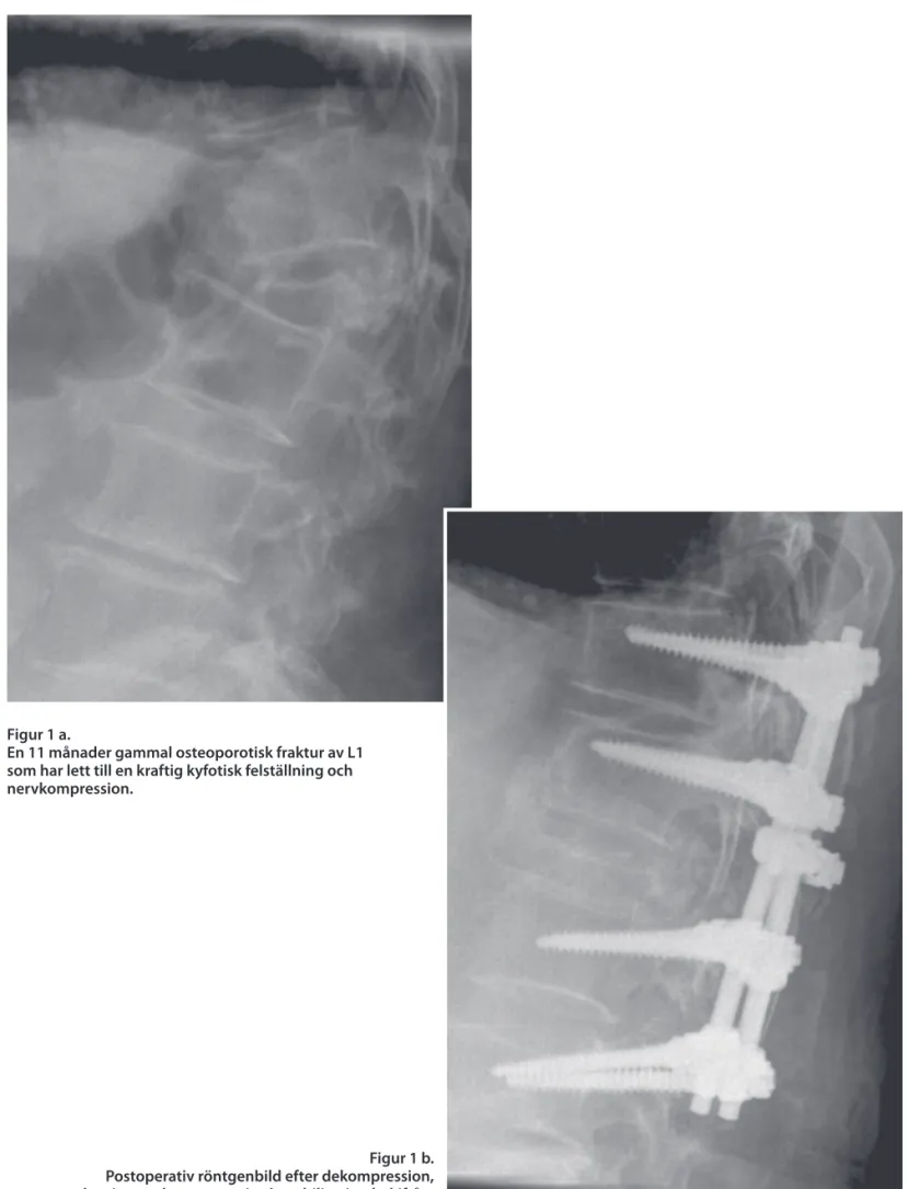 Figur 1 b.  Postoperativ röntgenbild efter dekompression,  korrigerande osteotomi och stabilisering bakifrån