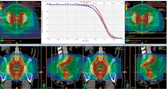 Fig. 5 Patient treated in pelvic region. MC vs AXB dose till medium distributions.  The insert shows DVHs for PTV (blue lines) and for GTV (red lines)