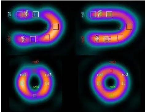 Figur 9 Placering av ROI:ar för kontrastberäkning i vertikala långaxelsnitt och 