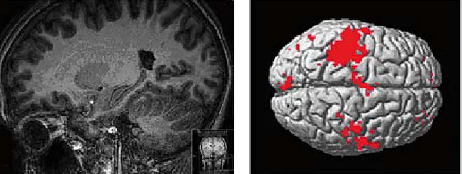Figur  2  visar  ytterligare  en  MRI-applika- MRI-applika-tion; funktionell MRI (fMRI)