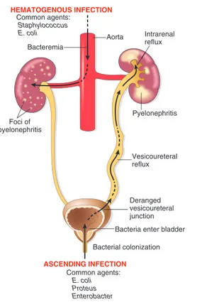 Figure  13–13   Pathways  of  renal  infection.  Hematogenous  infection  results  from  bacteremic  spread