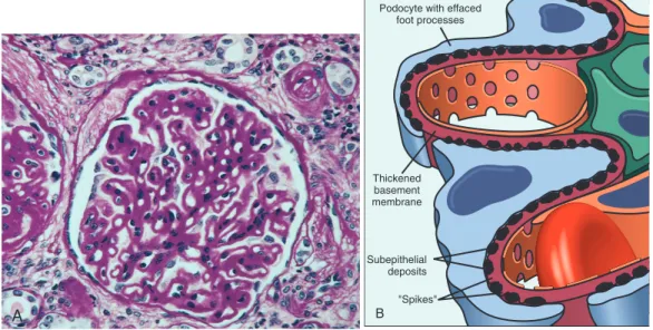 Figure  13–8   Membranous  nephropathy.  A,   Diffuse  thickening  of  the  glomerular  basement  membrane  (periodic  acid–Schiff  stain)